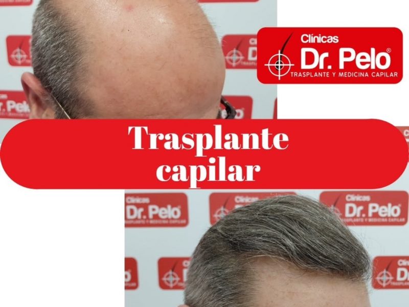 La solución definitiva para la alopecia avanzada: el injerto capilar más complejo se realiza en Sevilla